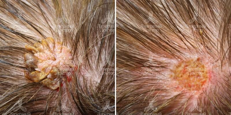 Удаление новообразования в волосах (фото)