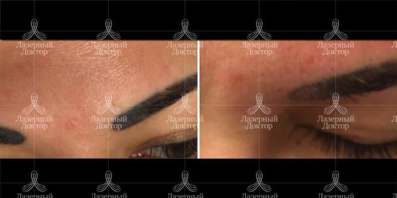 Удаление татуажа бровей (фото до и после процедуры)