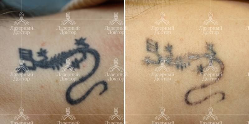 Сведение татуировки с шеи (фото до и после)