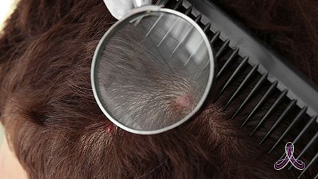 Удаление бородавок в голове волос thumbnail