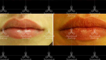 Увеличение губ филлерами на основе гиалуроновой кислоты