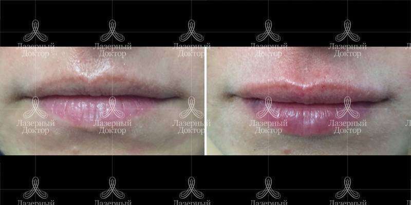 Гиалуроновая кислота в губах