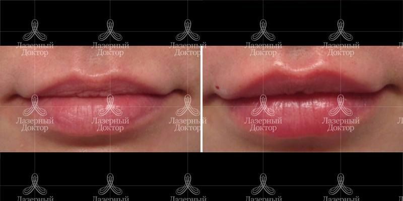Увеличение губ филлерами с гиалуронкой