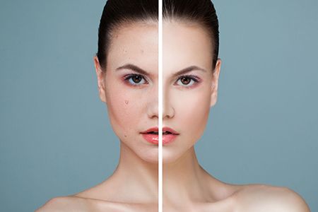 Фотоомоложение при куперозе