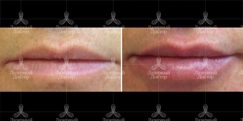 Фото губ с гиалуроновой кислотой