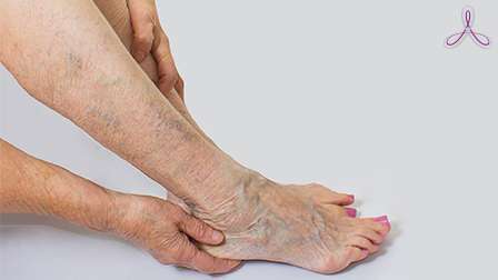 профилактика варикозного расширения вен ног