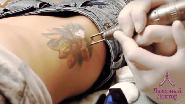 как выводят татуировки