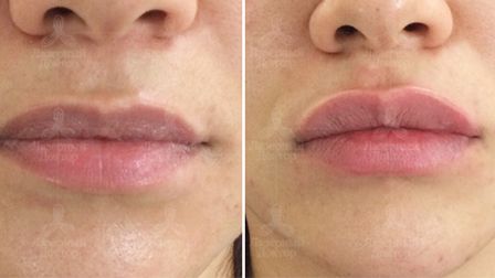 Увеличение губ (фото до и после)