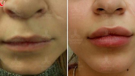 Гиалуроновая кислота в губах: фото до и после