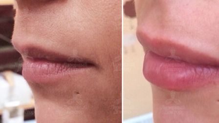 Фото до и после увеличения губ гиалуронкой